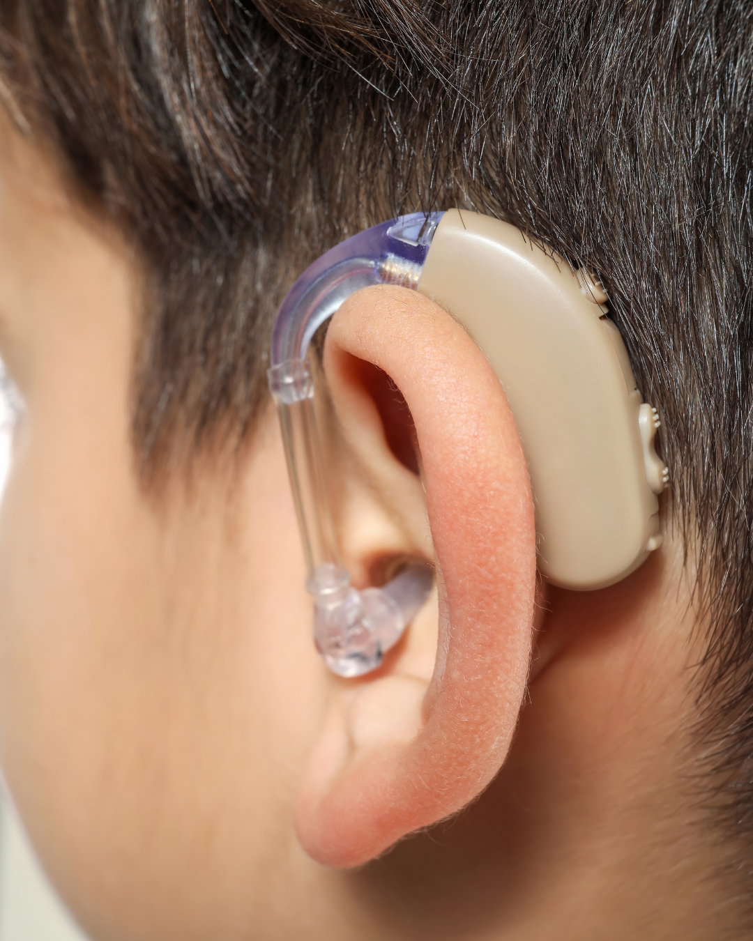 Audífono retroauricular en niño con pérdida auditiva, dispositivo médico para mejorar la audición infantil